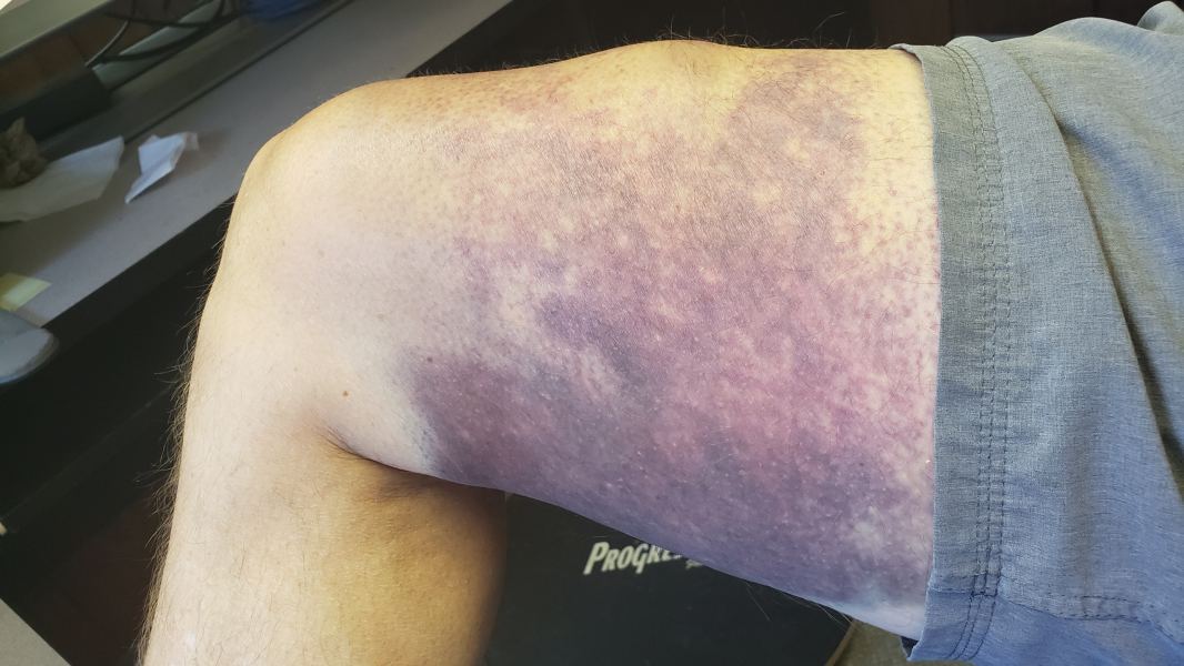 Foil Contact (not recommended)
Impact was just above the knee on top of the thigh but the bruising is obeying gravity
